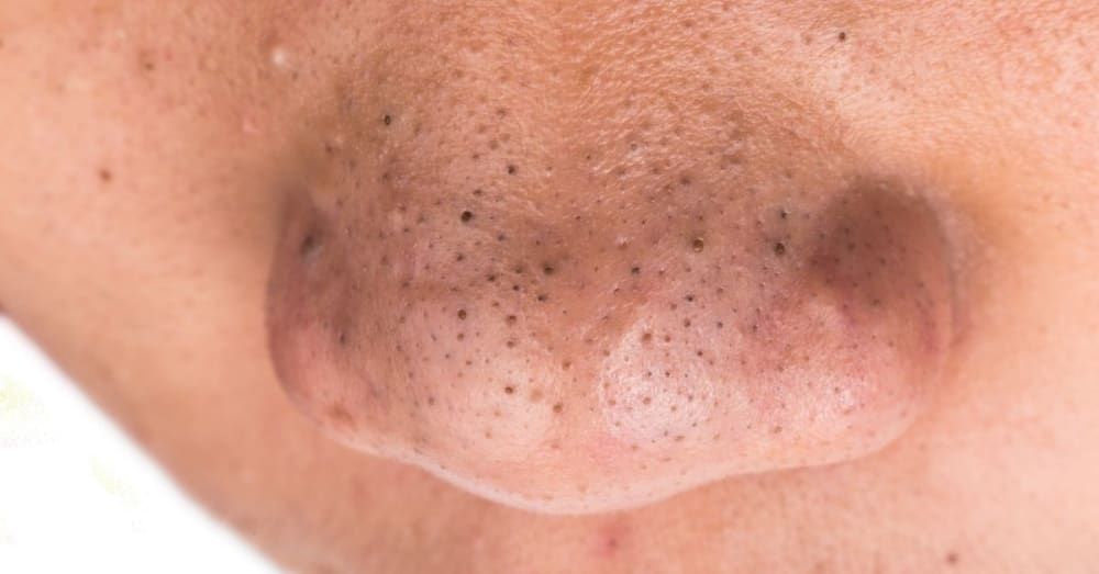 Blackheads