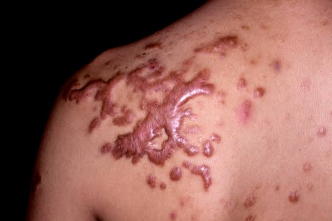 Keloids