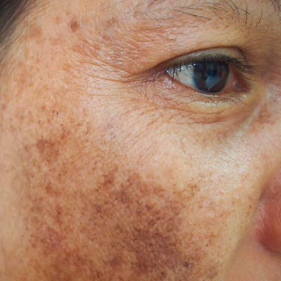 Hyperpigmentation