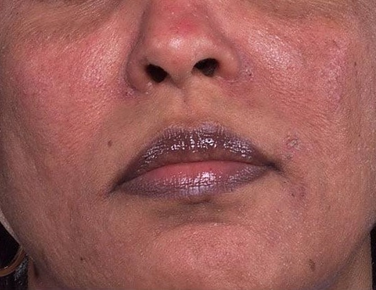 Rosacea