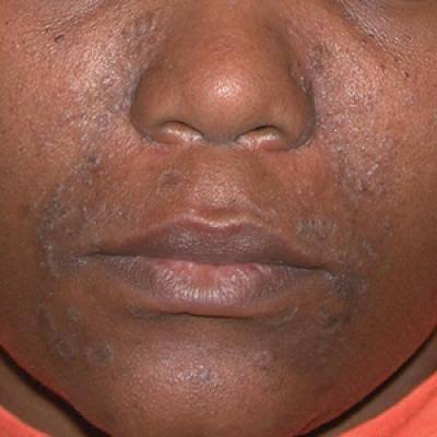 Eczema
