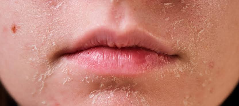 Dry Skin