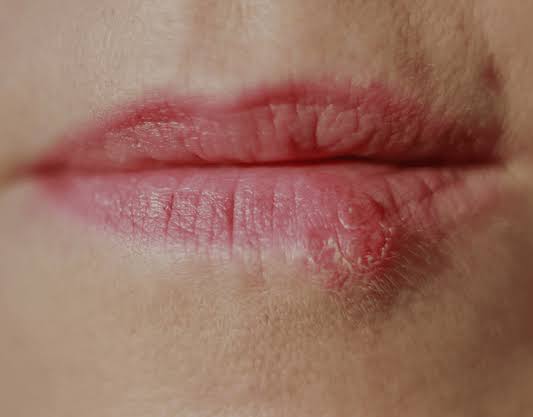 Cold Sores