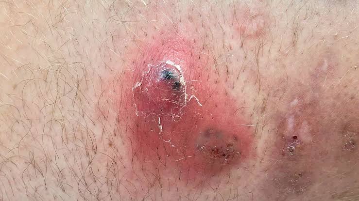 Ingrown Hairs